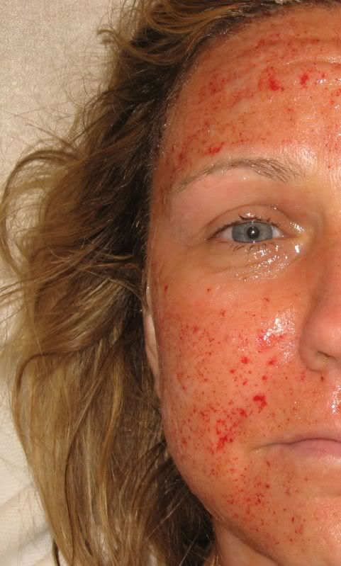 postopskin.jpg laser skin treatment immediately post-op picture by tiffanymarlene